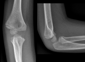 Figure 4B_0953789 Lateral condyle delayed union 2.jpg